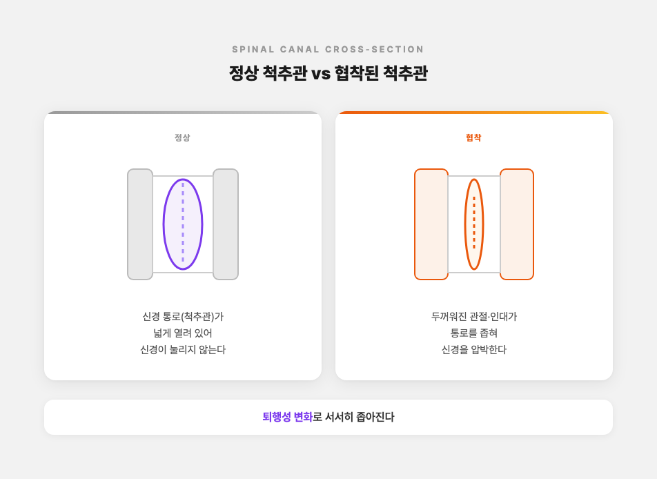 정상 척추관과 협착된 척추관을 단면 라인 아트로